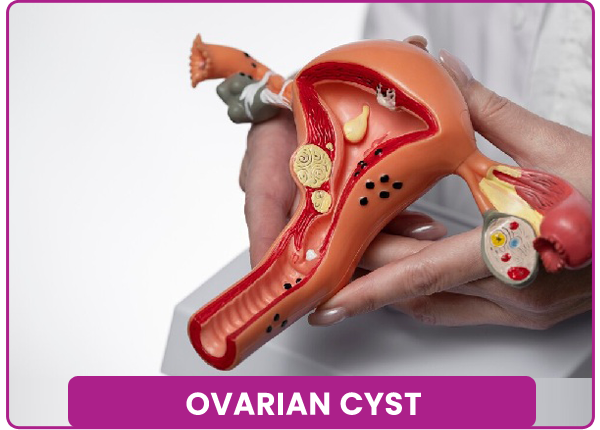 Ovarian Cyst