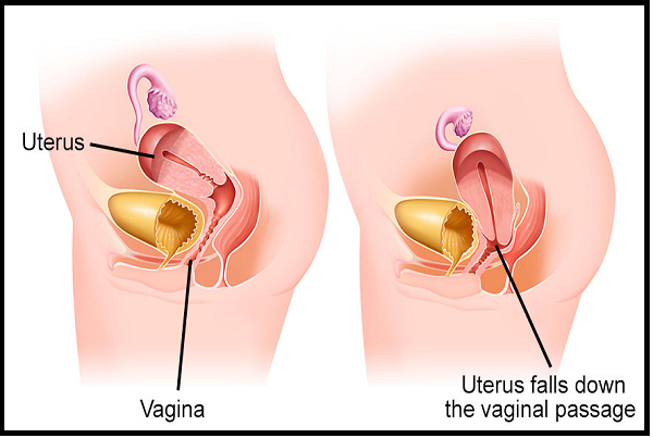 Prolapse
